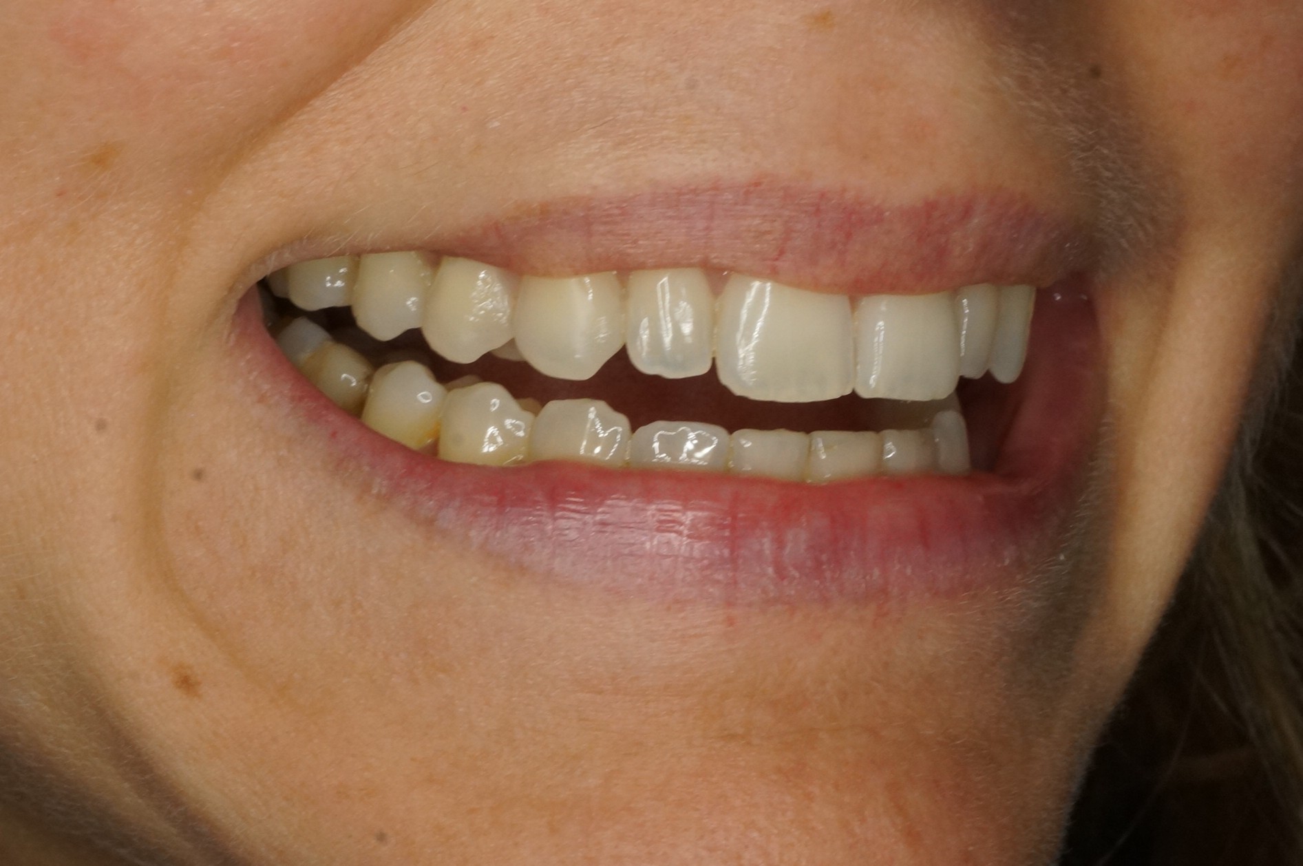 antes y después de carillas dentales naturales en clínica dental premium Barcelona