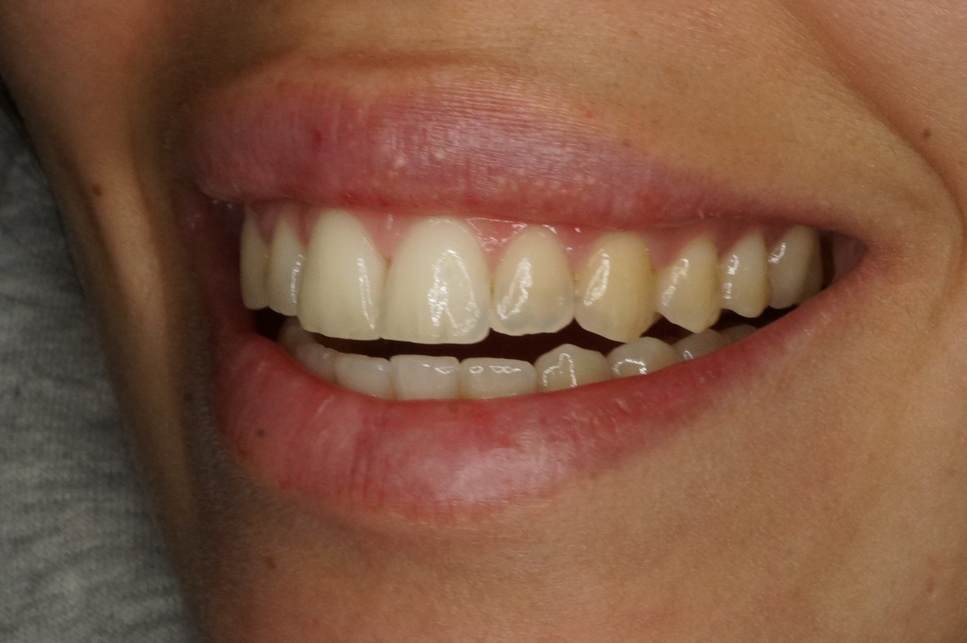 natural smile with veneers and professional whitening