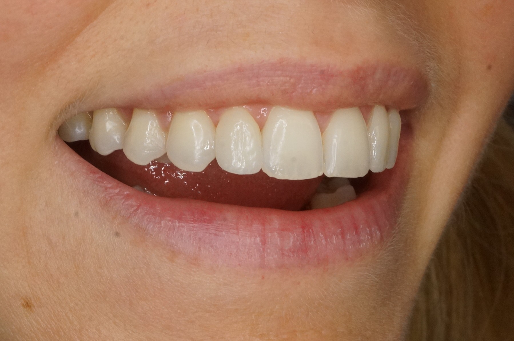 diseño de sonrisa con carillas de porcelana naturales en Barcelona
