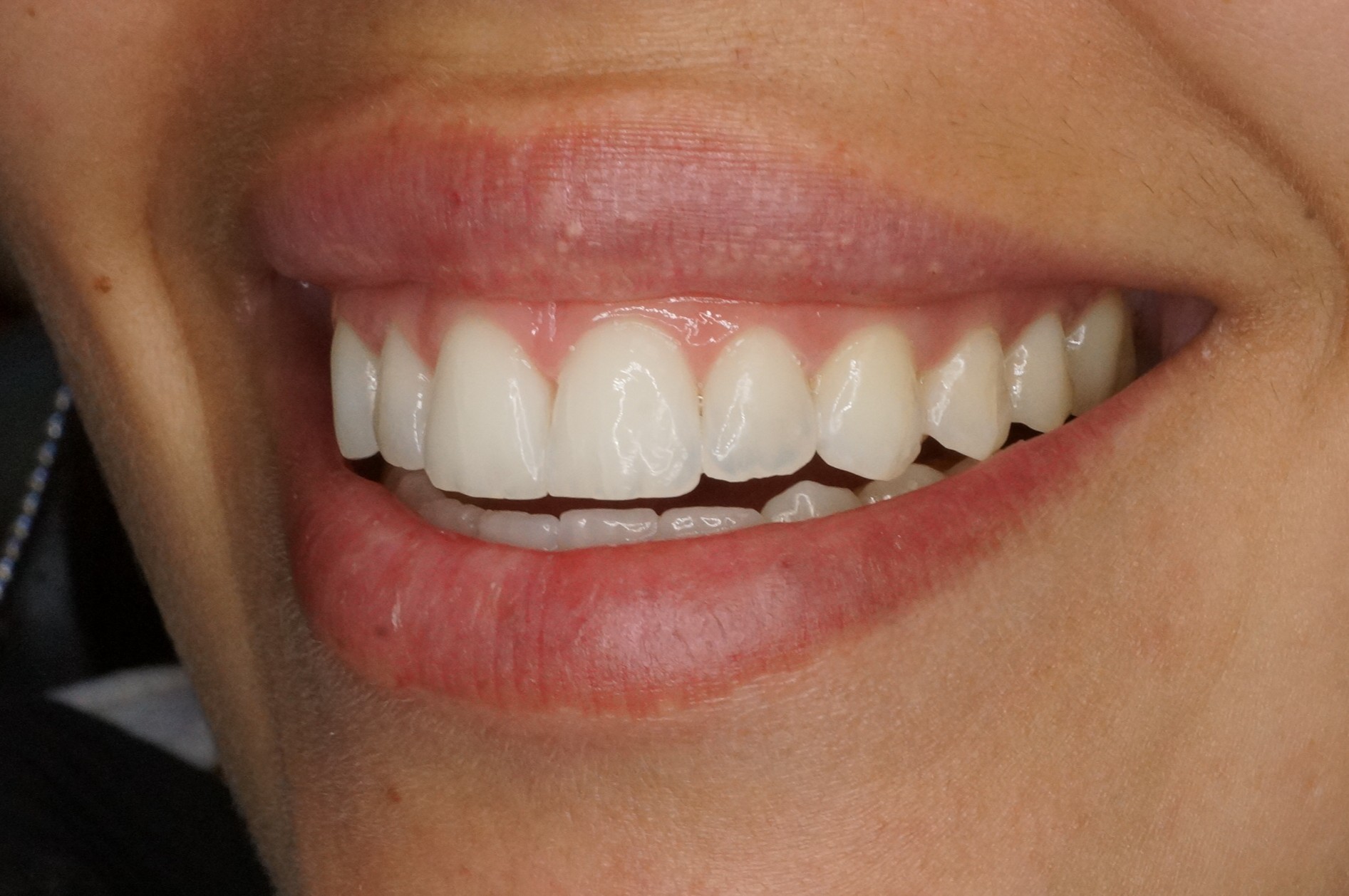 sonrisa natural y luminosa después de blanqueamiento dental profesional