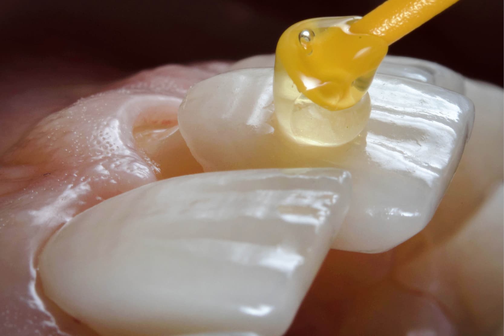 estética gingival antes de carillas dentales
