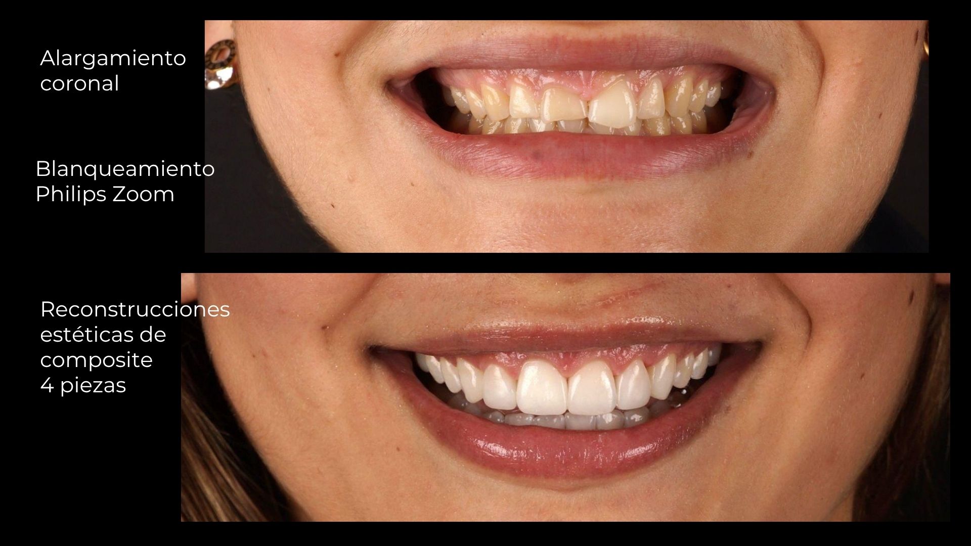 Minimally invasive composite bonding at SMITA Barcelona