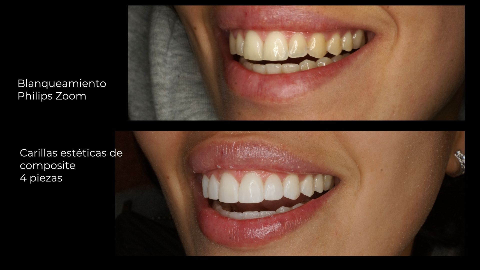 diseño de sonrisa natural en clínica dental SMITA Barcelona