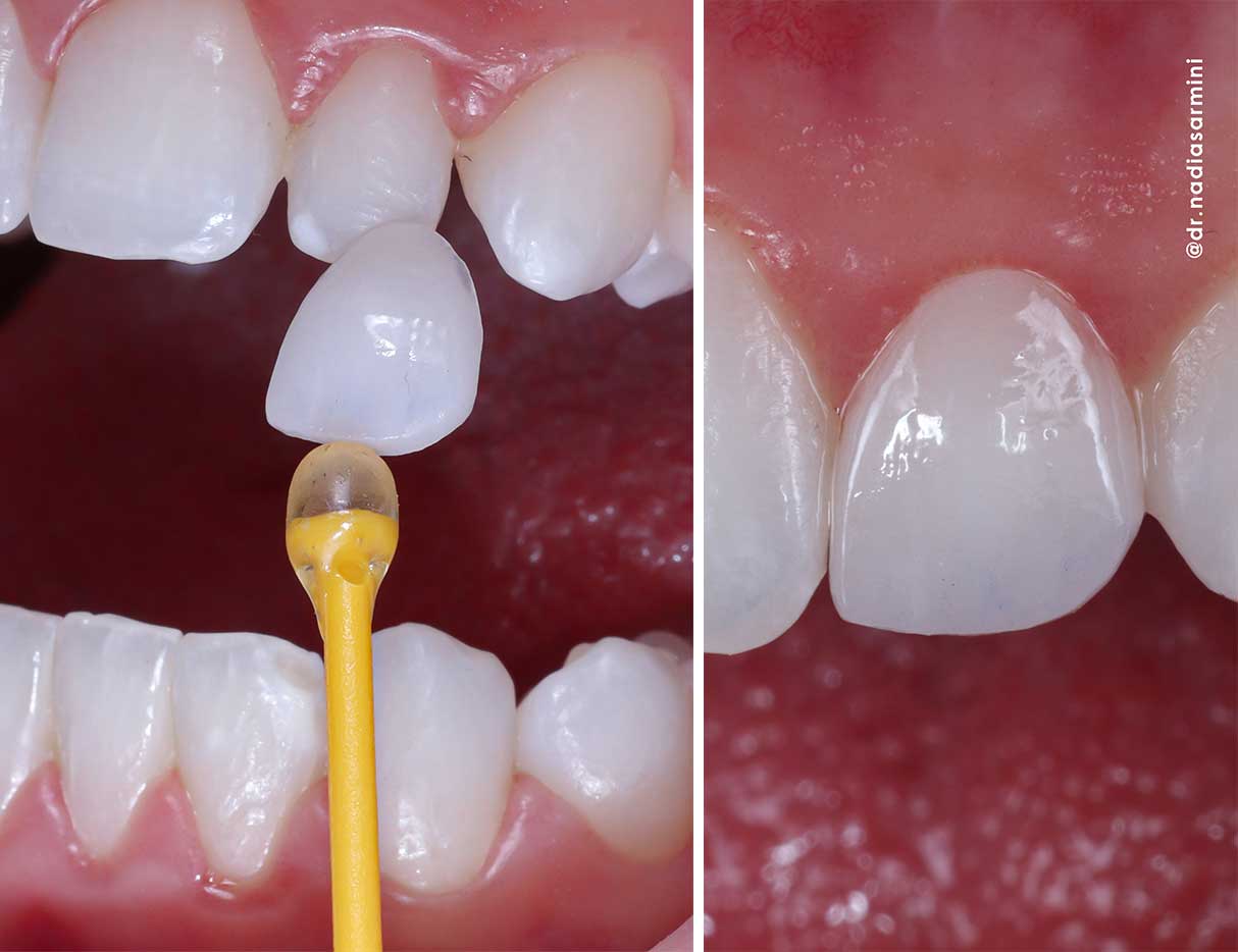 Adhesión de carillas de porcelana al esmalte dental