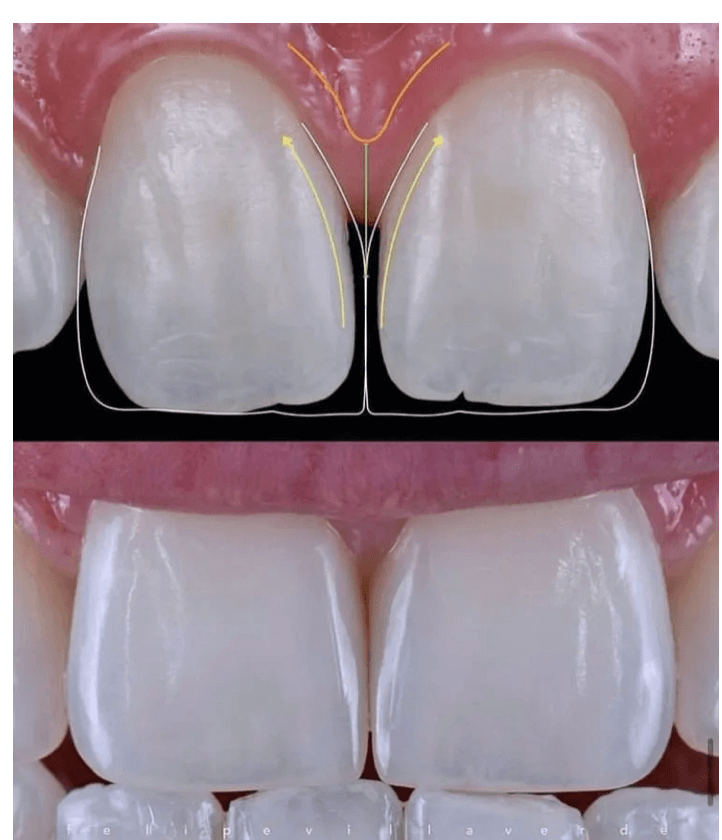carillas dentales naturales en SMITA Advanced Smile Design Barcelona