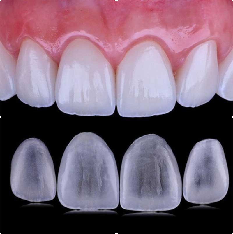 Carillas dentales naturales en Barcelona: cómo evitar una sonrisa artificial