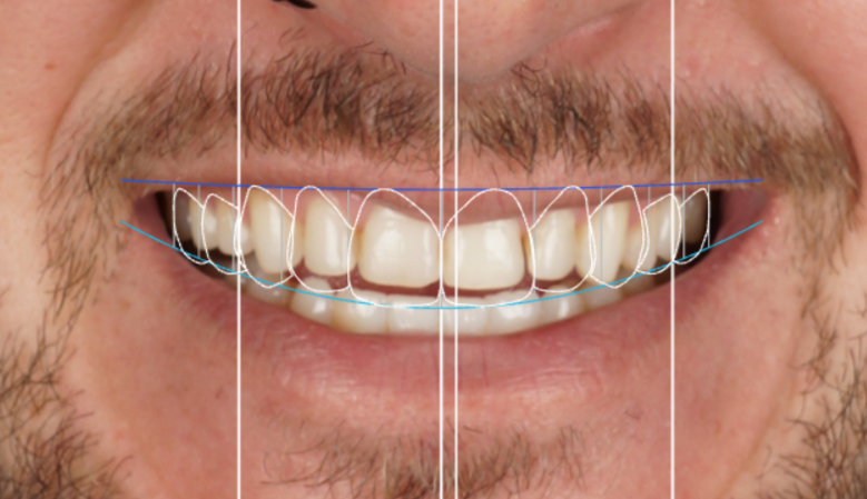 Personalised veneer treatment for an elegant natural smile in Barcelona