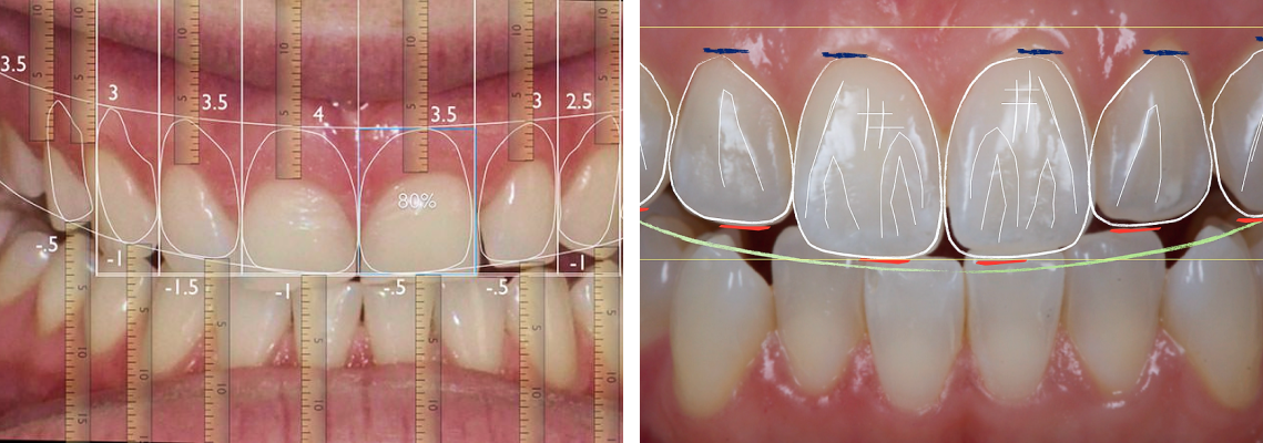 carillas de porcelana naturales para una sonrisa elegante en Barcelona