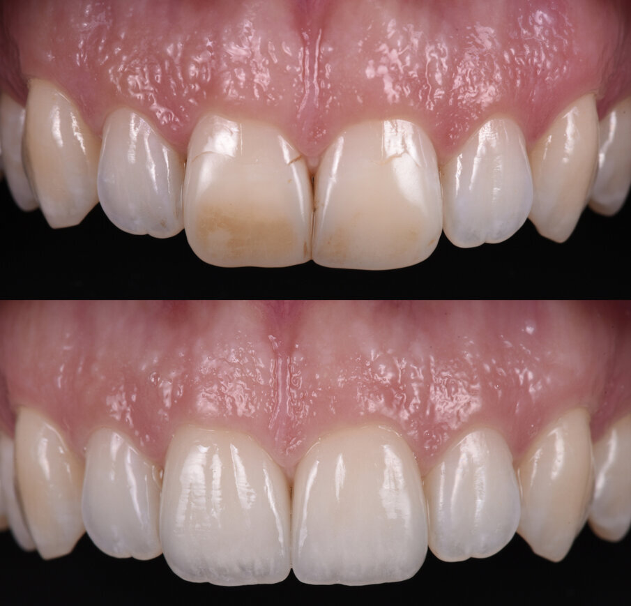 carillas de porcelana con textura y translucidez natural