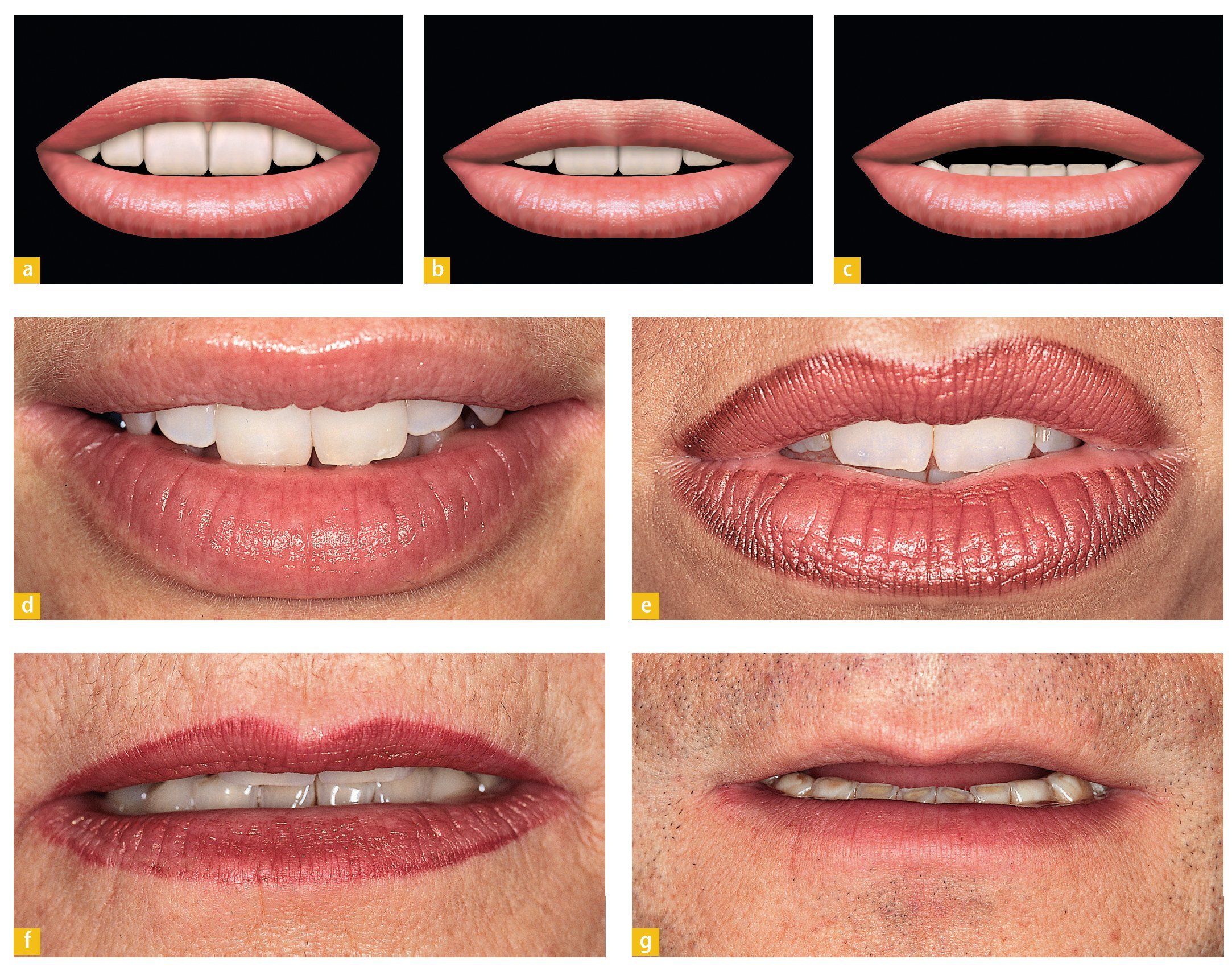 comparación de colores dentales para diseño de sonrisa personalizado
