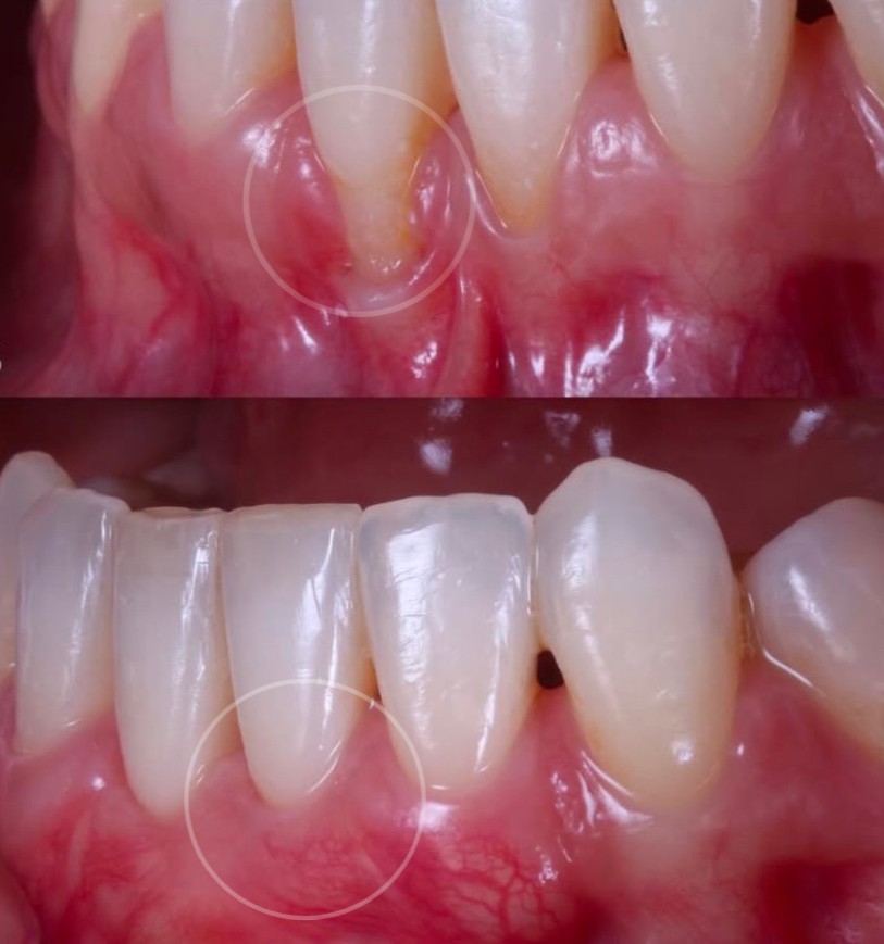 recesion gingival tratamiento injerto de encia