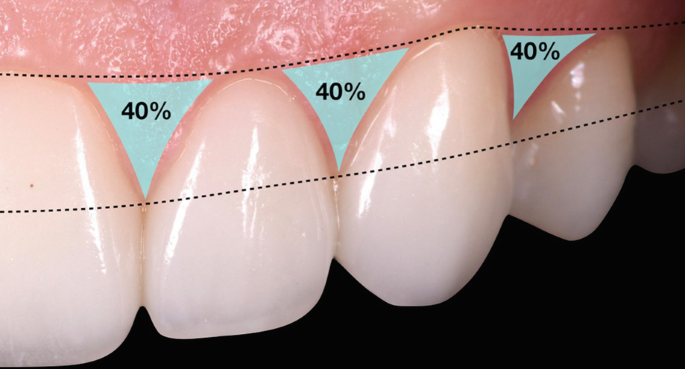 sonrisa personalizada con proporciones dentales armónicas