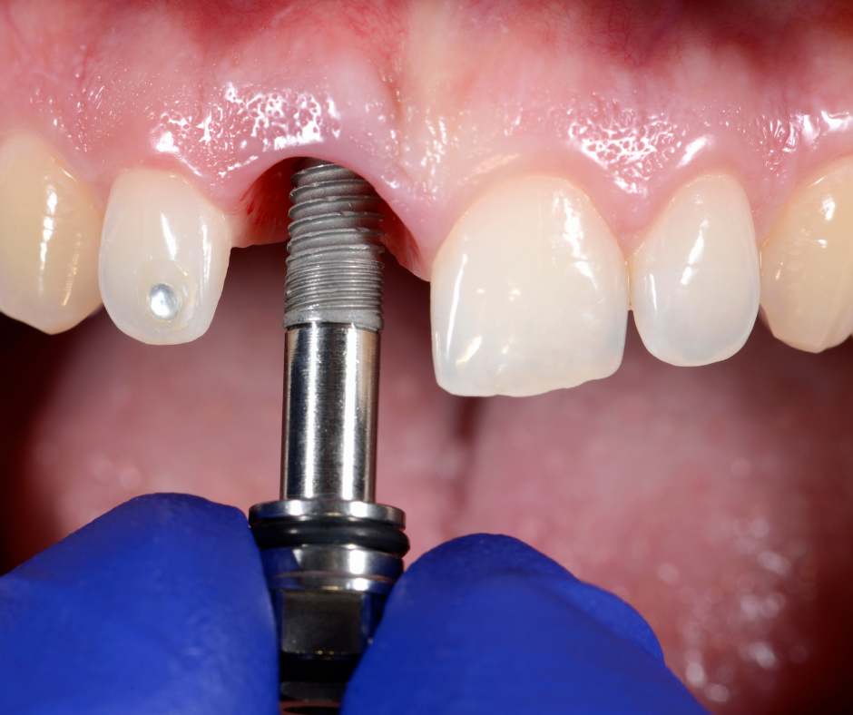 implante diente anterior estetica barcelona