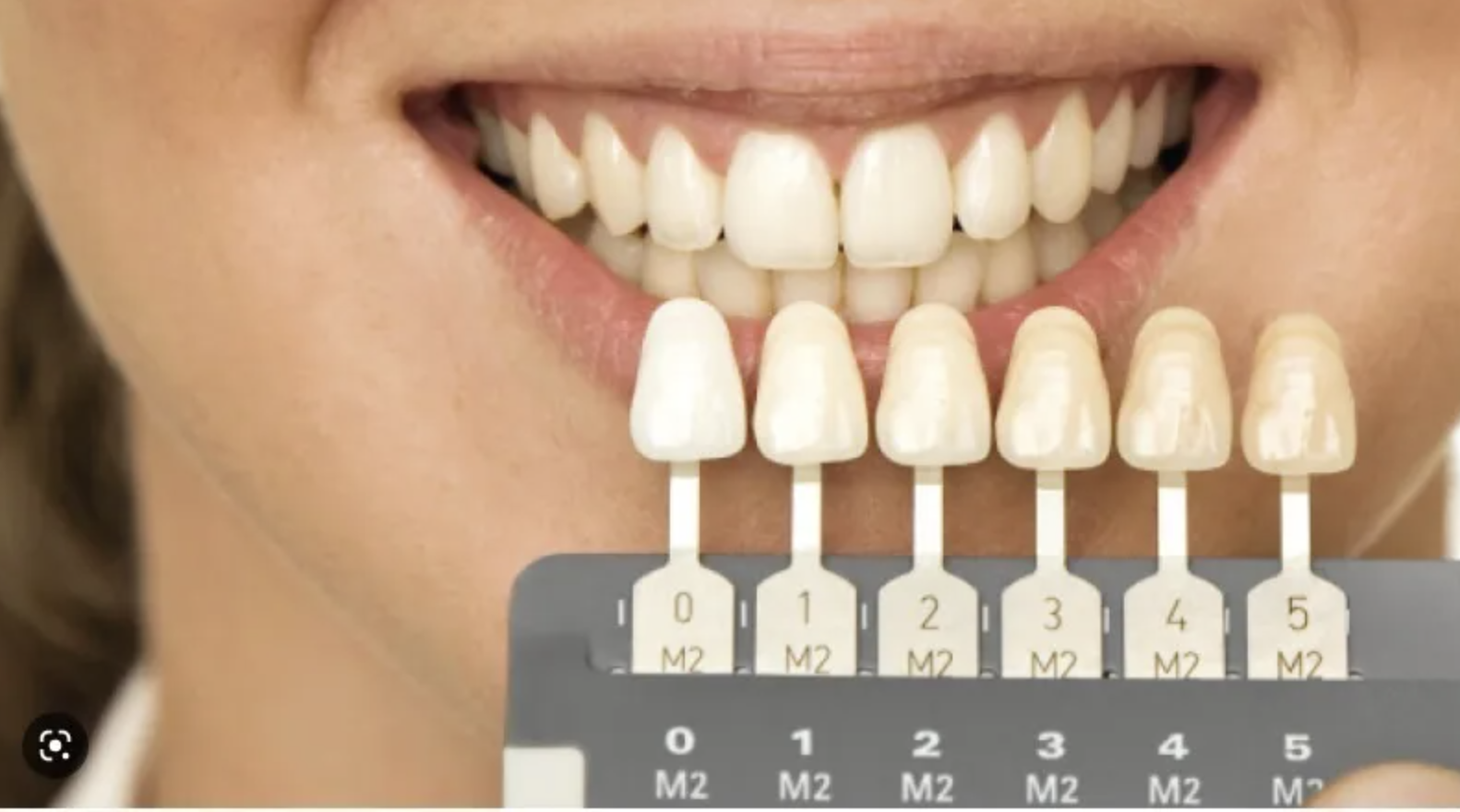 elección de color dental natural en SMITA Advanced Smile Design Barcelona