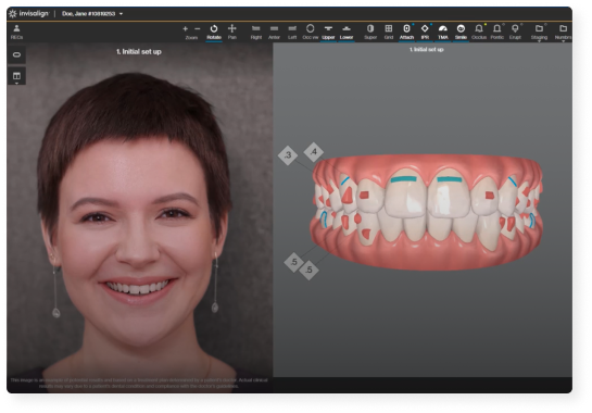 Planificación digital de una sonrisa natural antes de carillas