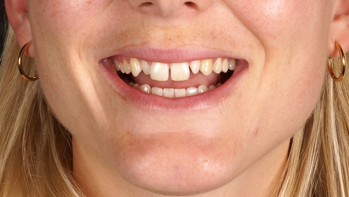 diseño de sonrisa personalizado antes de carillas de porcelana en SMITA