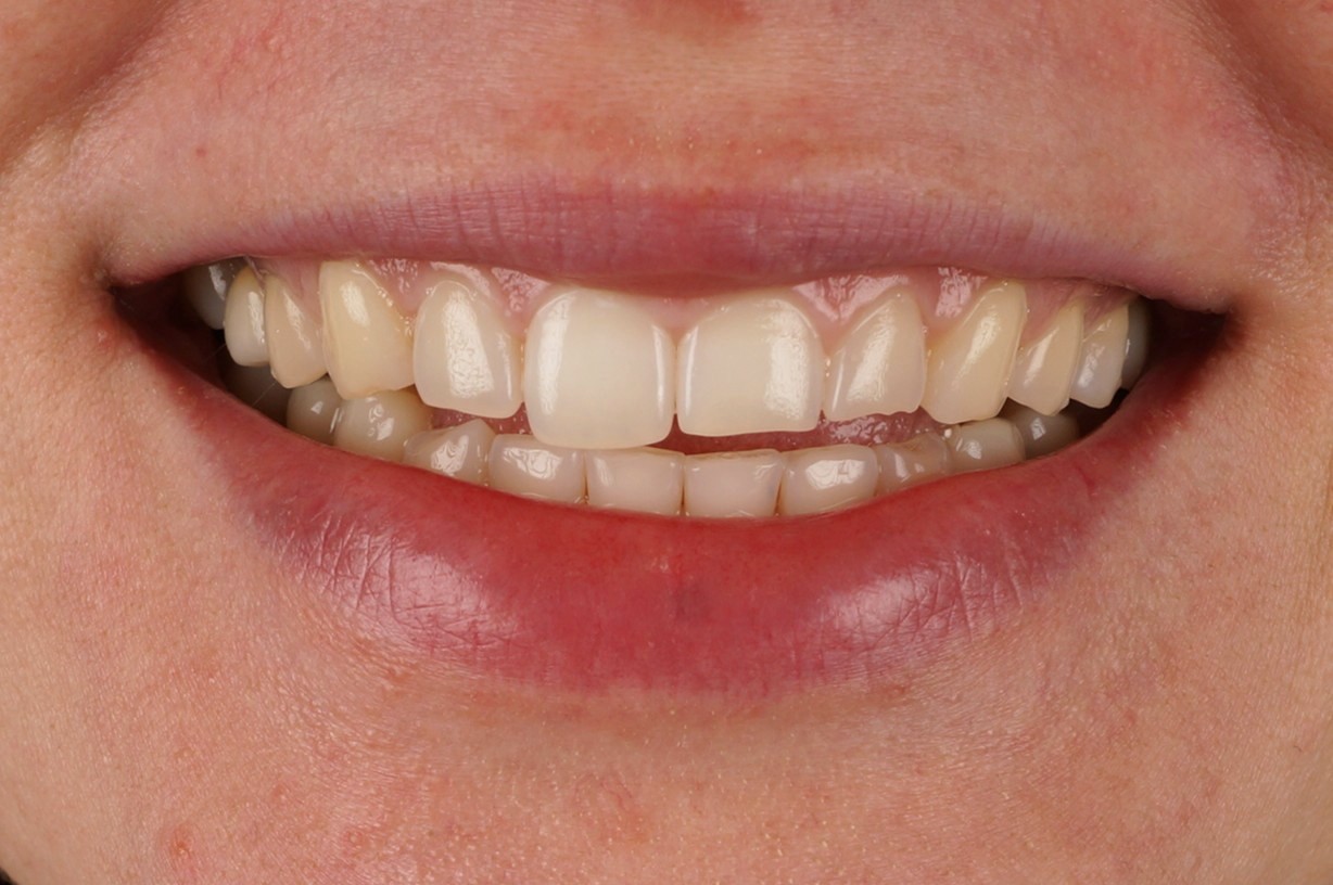 reconstrucción conservadora de dientes desgastados con composite