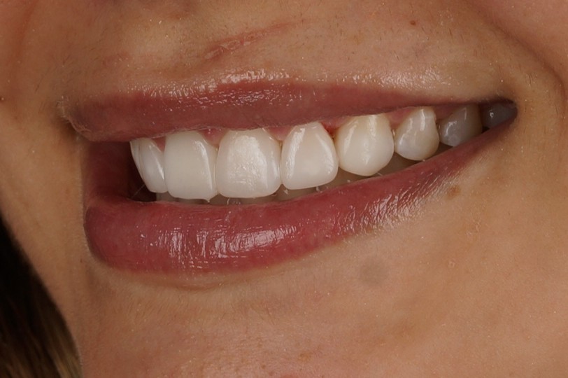 diseño de sonrisa personalizado con blanqueamiento, carillas y ortodoncia invisible