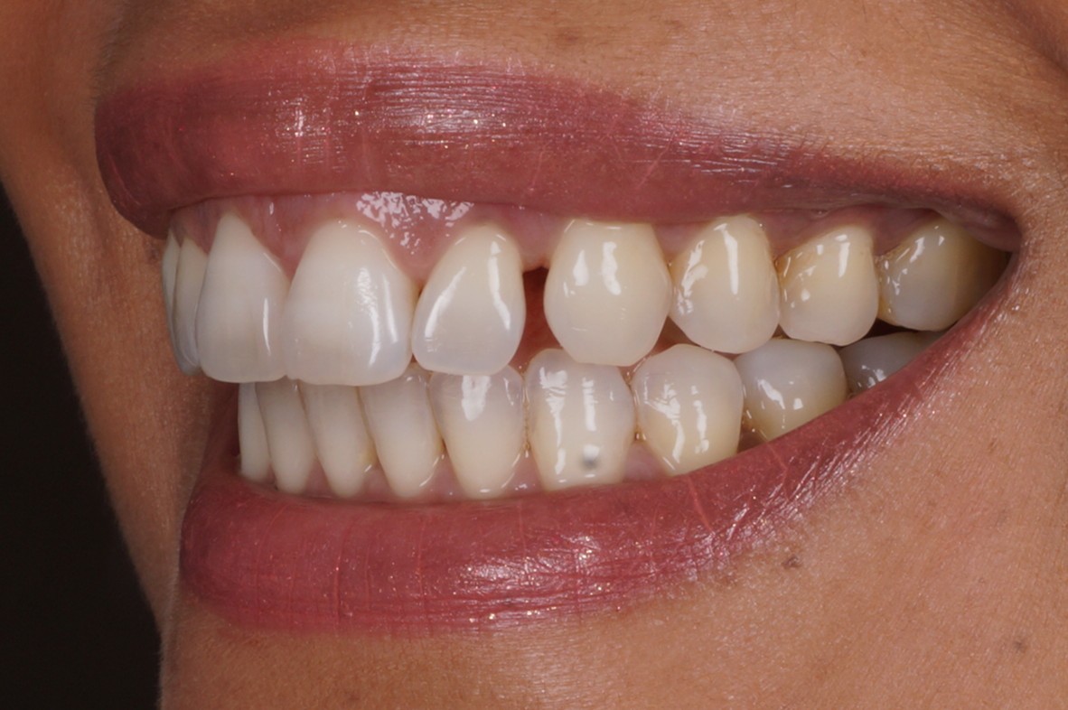 caso real cierre espacio dental con composite