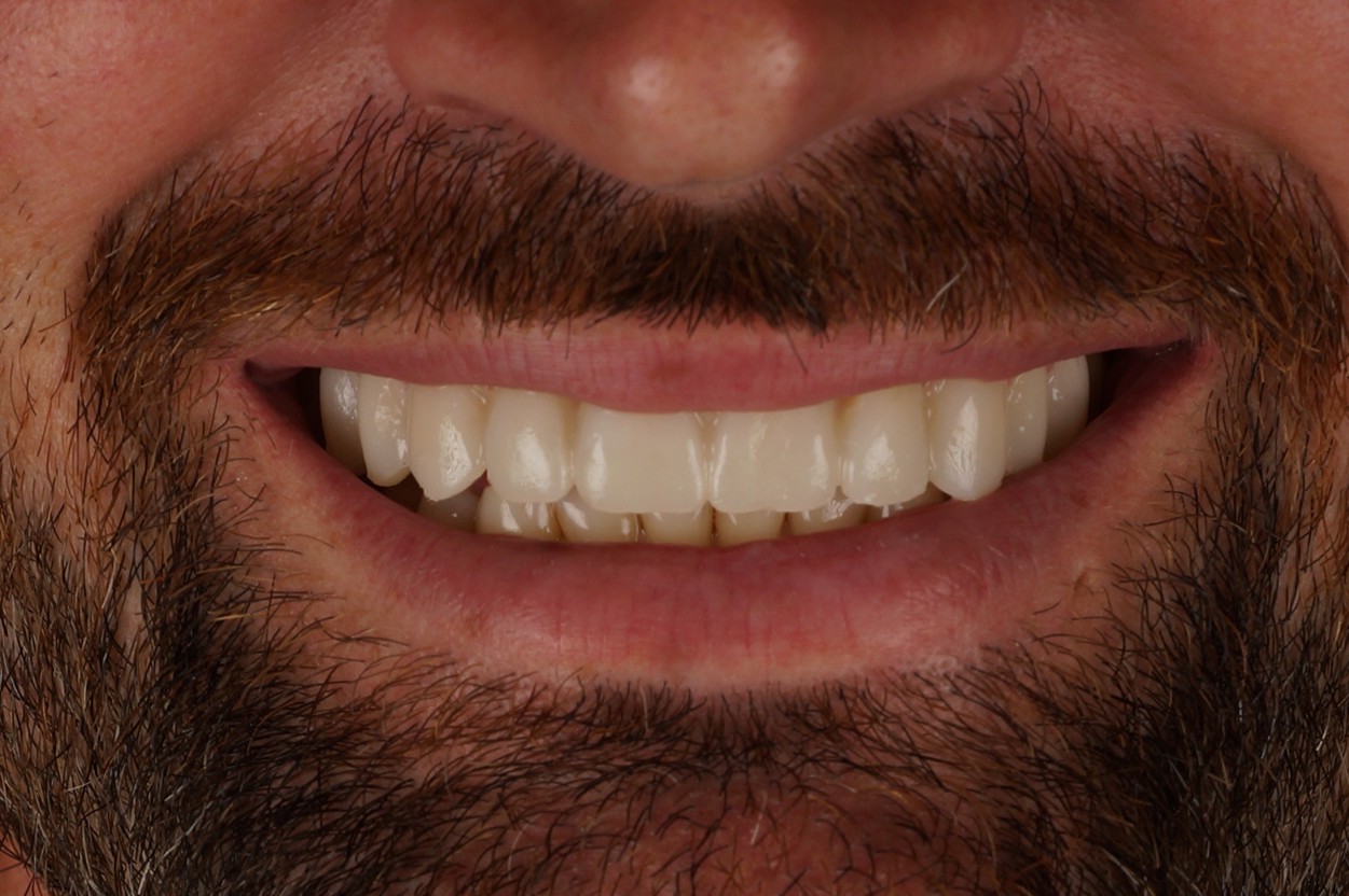 caso real mock up diseño de sonrisa