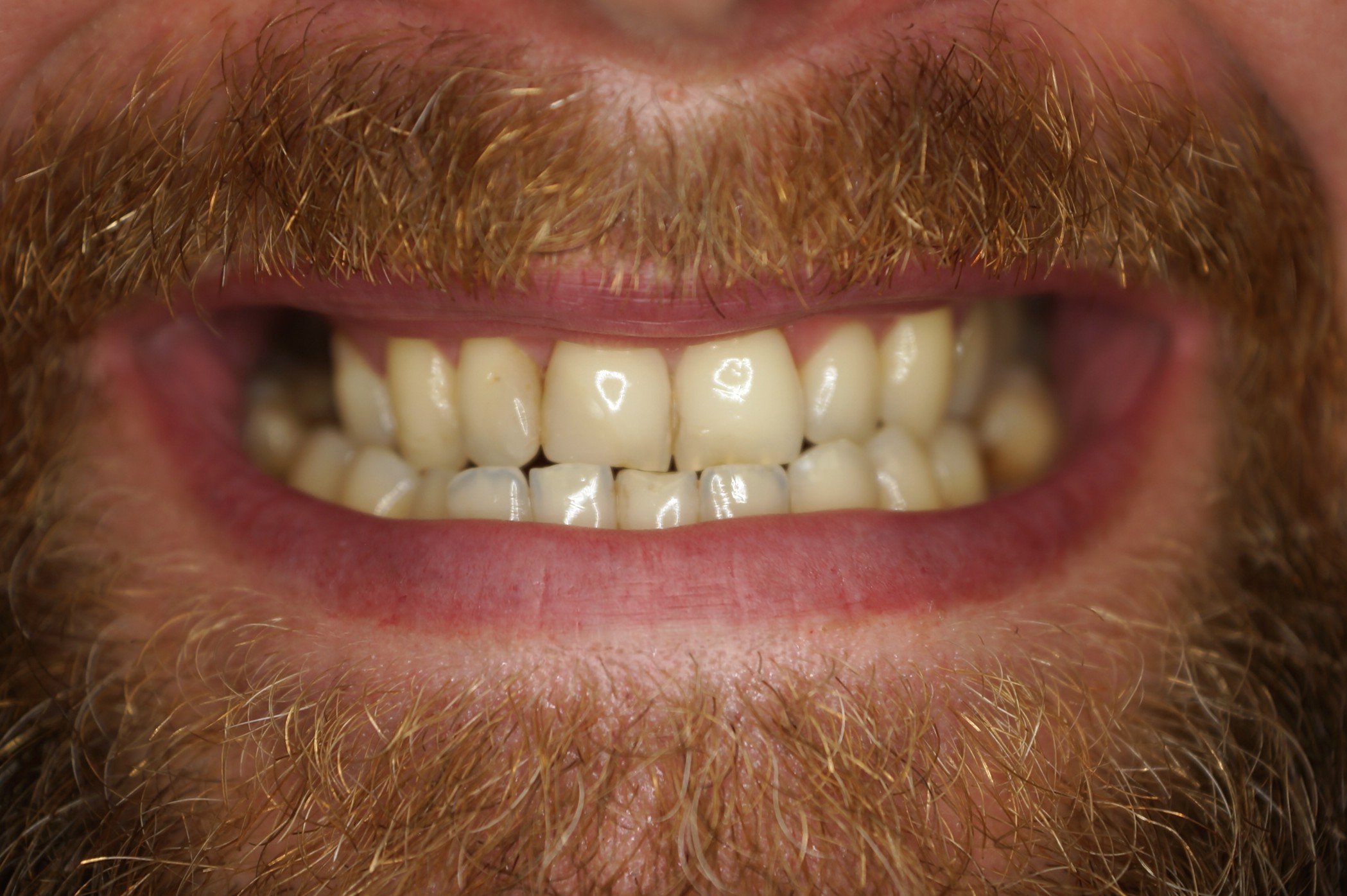 caso real ortodoncia y diseño de sonrisa
