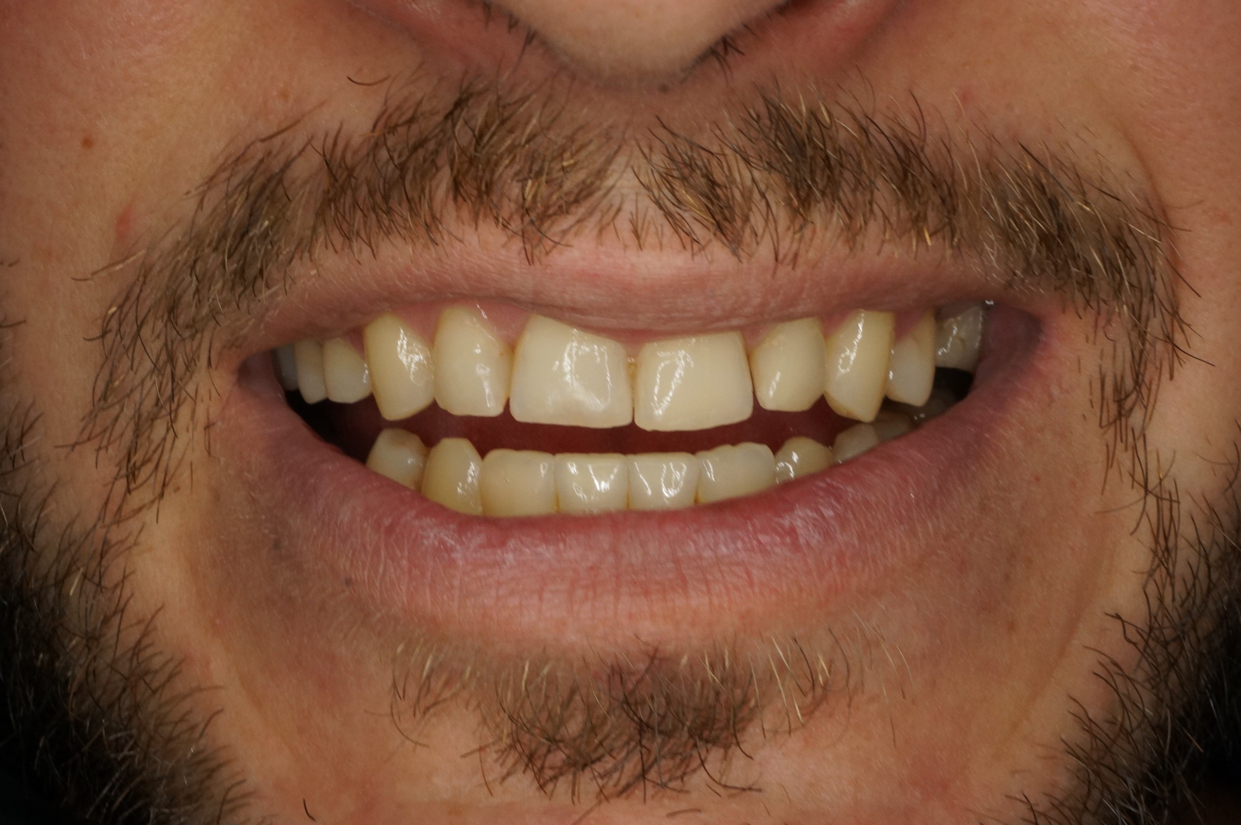 carillas de composite o porcelana en SMITA Barcelona