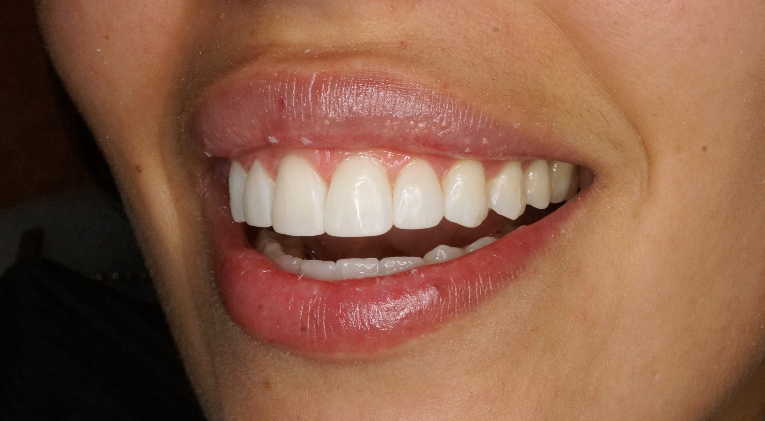 Blanqueamiento y reconstrucciones con composite - After