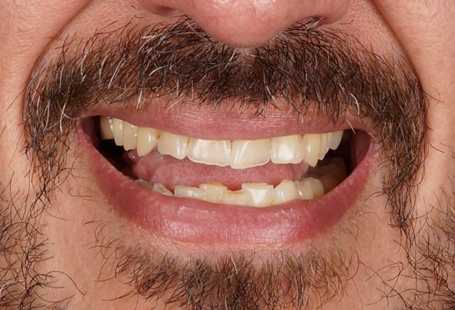 transformación de sonrisa natural con carillas de porcelana en SMITA Barcelona