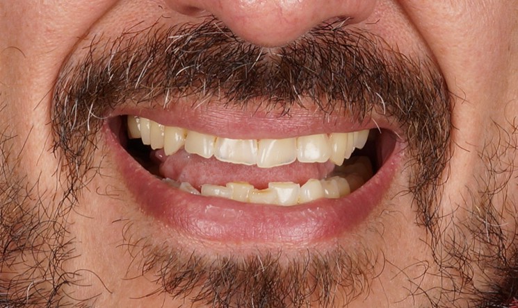 transformación de sonrisa natural con carillas de porcelana en SMITA Barcelona