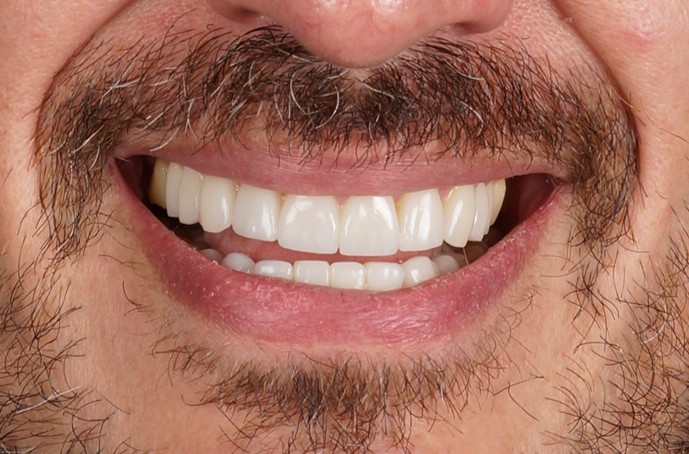 SMITA porcelain veneer case with natural tooth proportions
