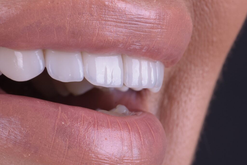 Análisis de línea de sonrisa y relación con el labio inferior