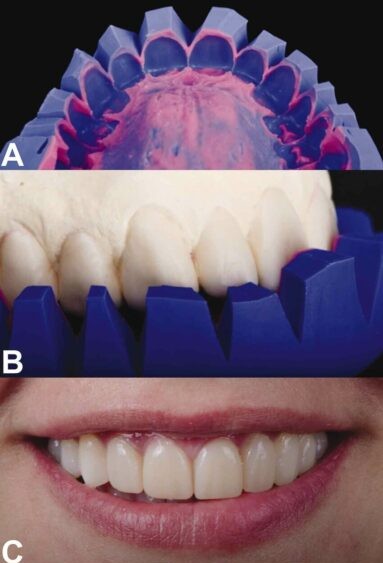 Mock-up de diseño de sonrisa relacionado con labios y armonía facial