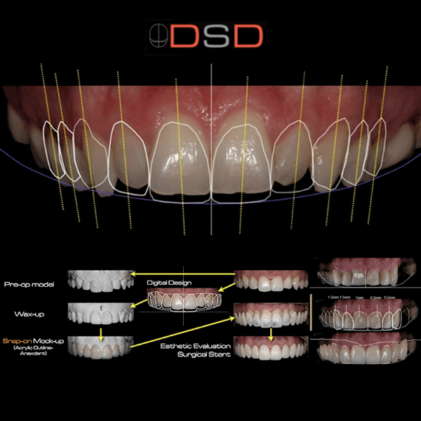 proporciones dentales y armonía facial en un diseño de sonrisa natural