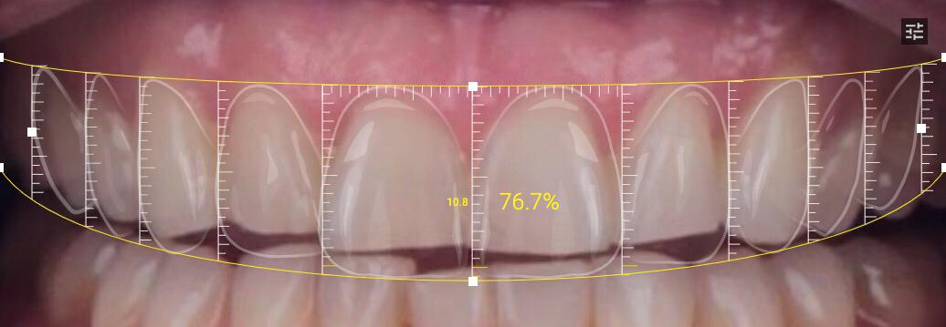 Análisis de sonrisa durante una consulta de estética dental en Barcelona
