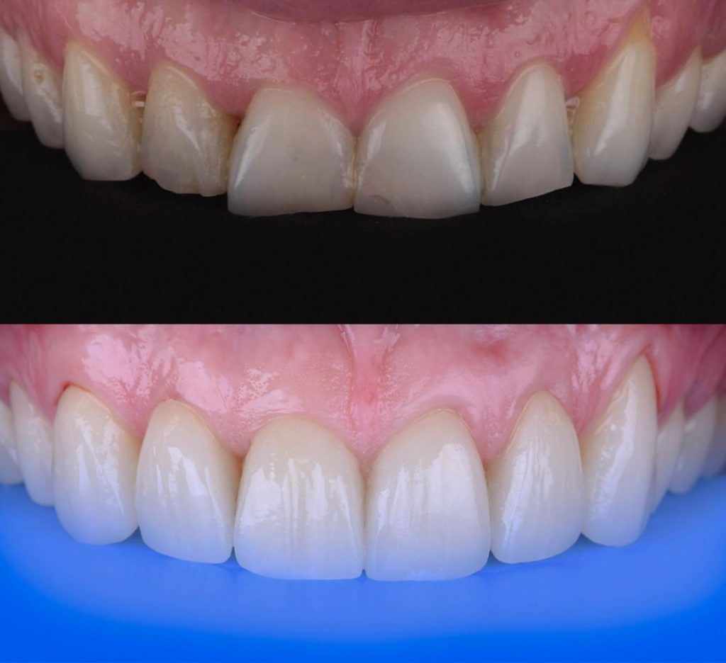 análisis de mordida antes de realizar carillas dentales