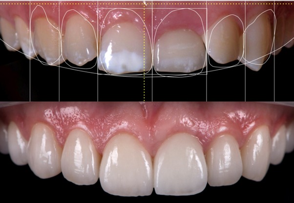 simetría gingival en los dientes anteriores