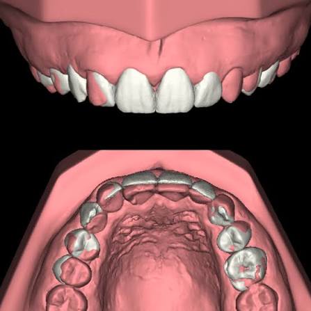 mock up dental