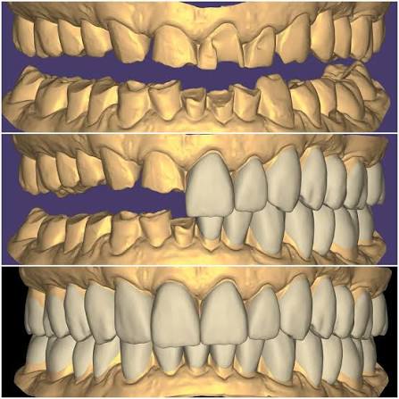 Análisis de proporciones dentales mediante mock-up en Barcelona