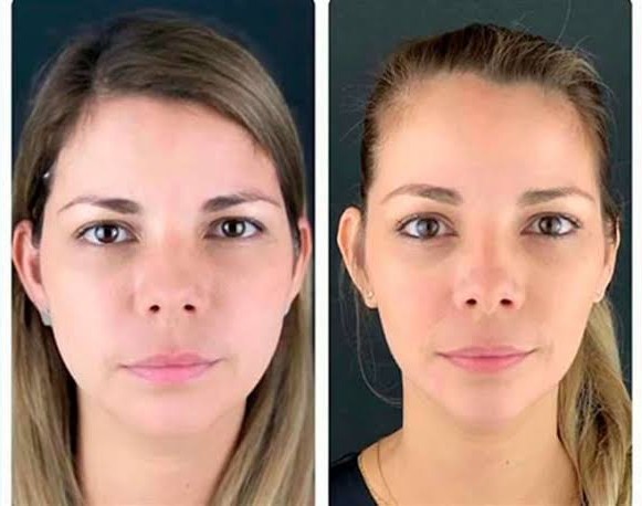 cara con bruxismo y sin