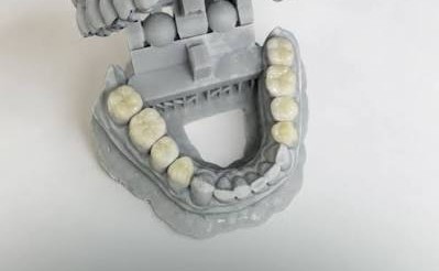 evaluación funcional antes de un tratamiento estético dental