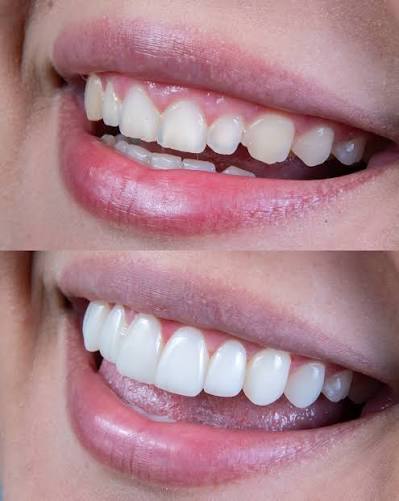simetría gingival en los dientes anteriores