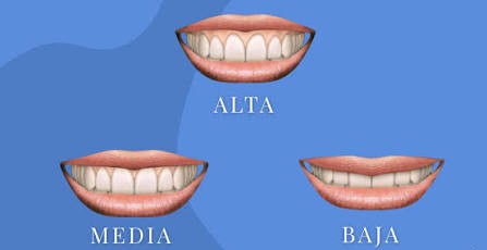 cómo la línea gingival influye en las proporciones dentales