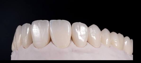 elección de color para carillas de porcelana naturales