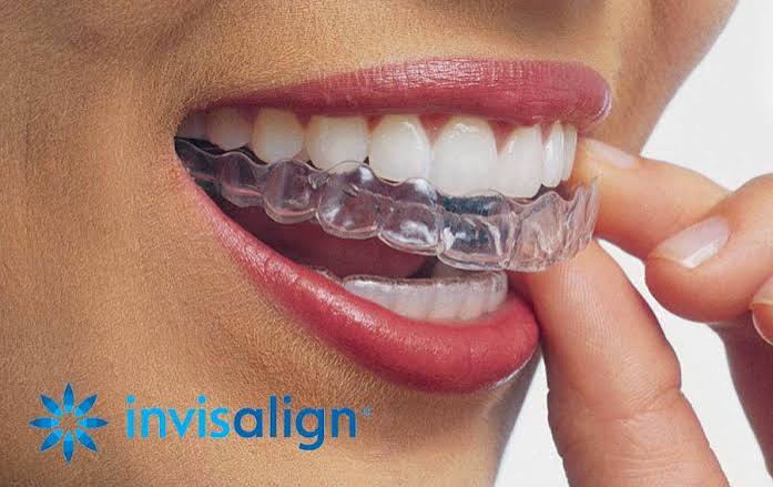 invisalign barcelona