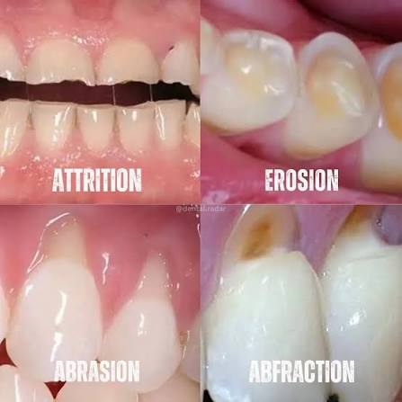 tratamiento de dientes desgastados en SMITA Barcelona