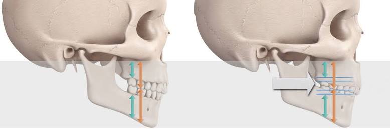 aumento dimension vertical dental barcelona