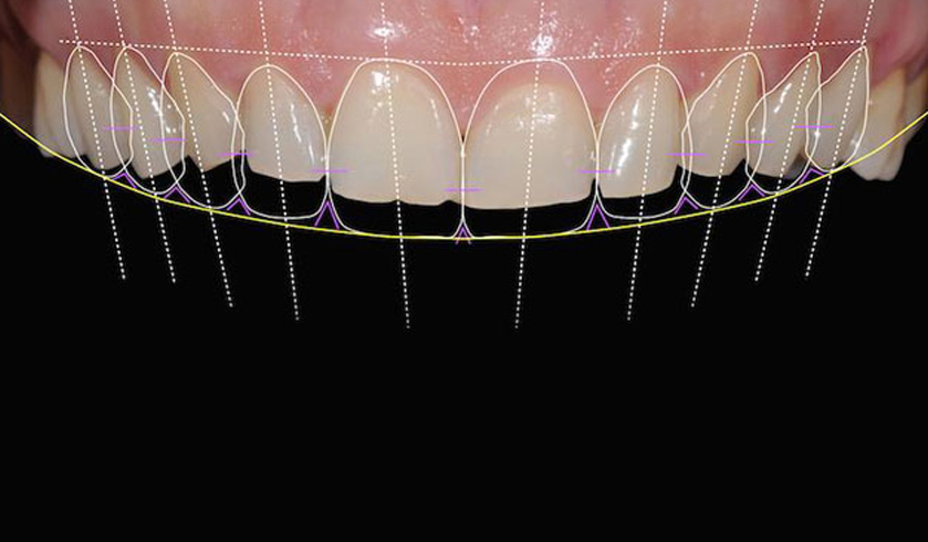 diseño de sonrisa para recuperar dientes cortos y desgastados