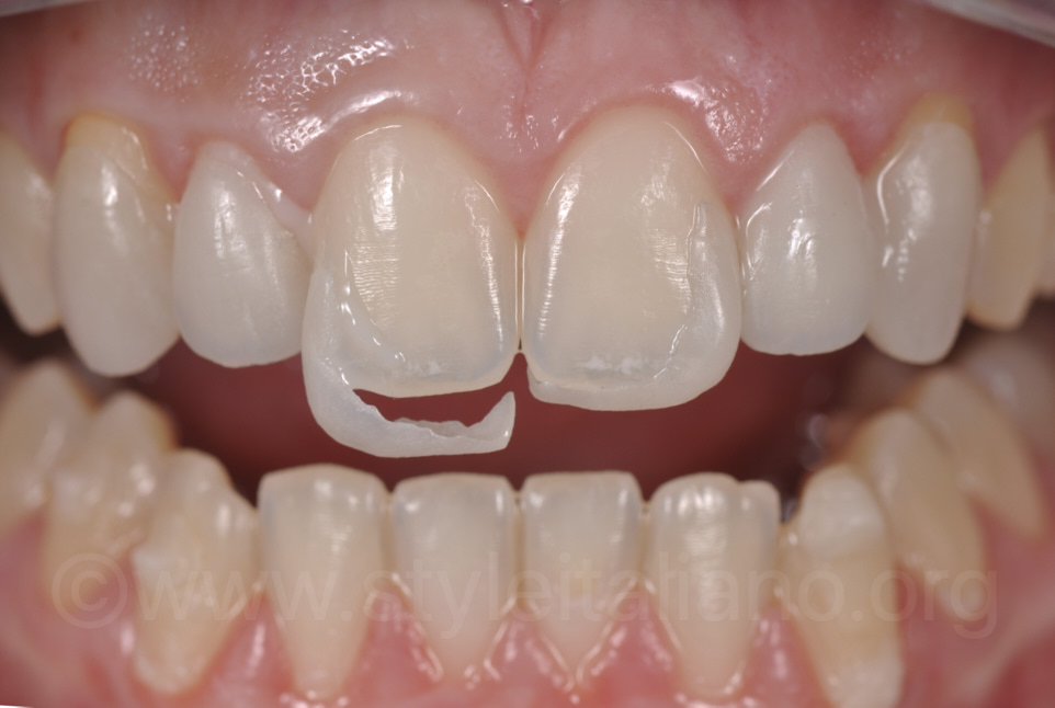 Mock-up dental: prueba tu nueva sonrisa antes del tratamiento