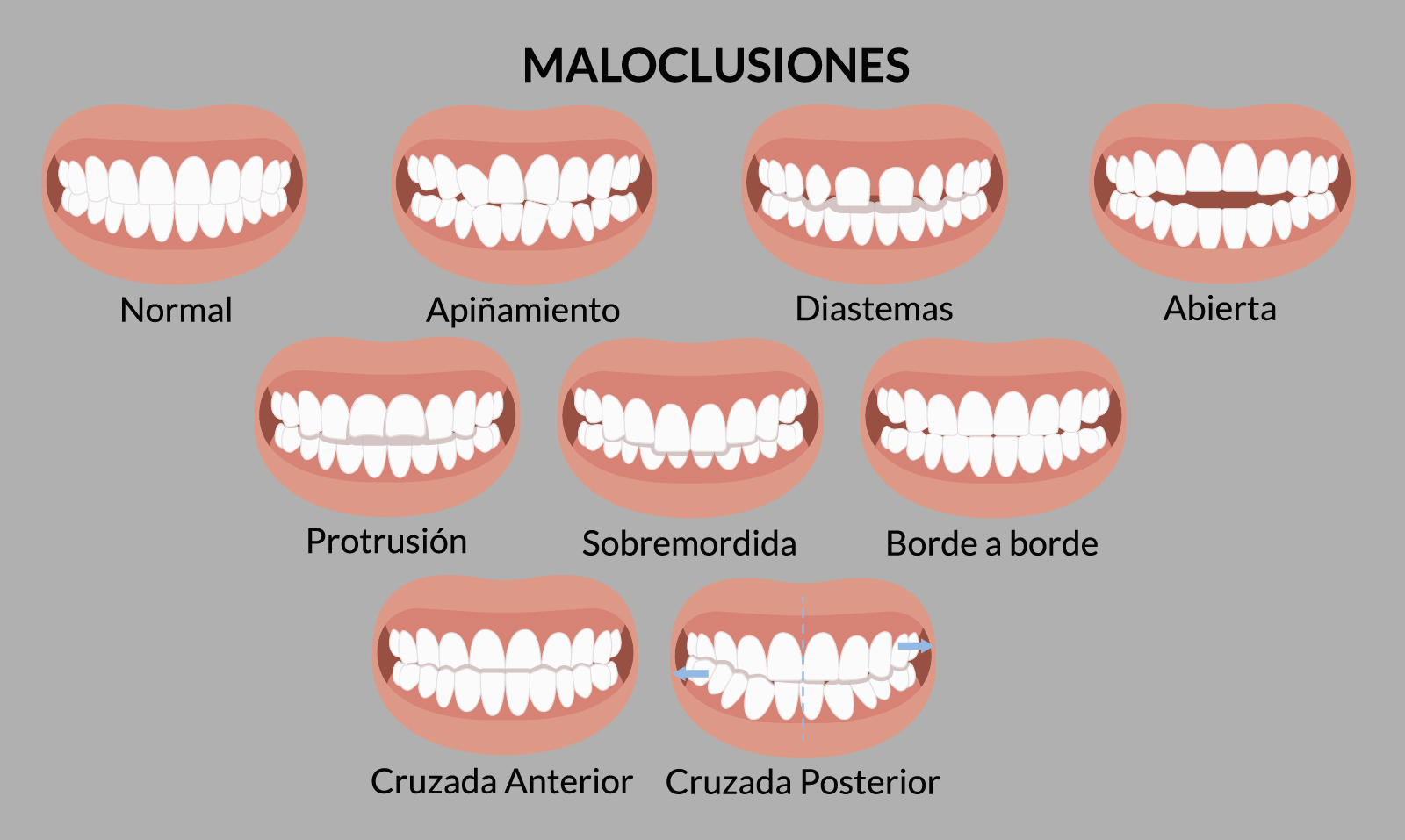 análisis de mordida antes de reconstruir dientes desgastados