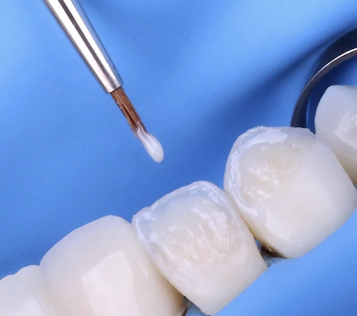 carillas de composite para corregir forma y bordes dentales
